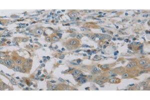 Immunohistochemistry of paraffin-embedded Human breast cancer using MAP2K6 Polyclonal Antibody at dilution of 1:30 (MAP2K6 抗体)