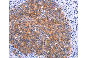 Immunohistochemistry of Human thyroid cancer using PTPN13 Polyclonal Antibody at dilution of 1:30 (PTPN13 抗体)