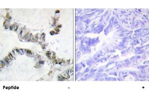Immunohistochemistry analysis of paraffin-embedded human colon carcinoma tissue, using HMGXB3 polyclonal antibody . (HMGXB3 抗体)