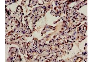 Immunohistochemistry analysis of human lung cancer using ABIN7145820 at dilution of 1:100 (BRD8 抗体  (AA 641-859))