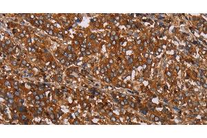 Immunohistochemistry of paraffin-embedded Human liver cancer tissue using MFAP5 Polyclonal Antibody at dilution 1:40 (MFAP5 抗体)