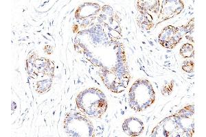 Formalin-fixed, paraffin-embedded human Breast Carcinoma stained with SM-MHC Monoclonal Antibody (SMMS-1). (MYH11 抗体)