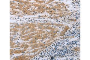 Immunohistochemistry of Human liver cancer using TNK2 Polyclonal Antibody at dilution of 1:70 (TNK2 抗体)