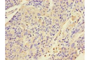 Immunohistochemistry of paraffin-embedded human cervical cancer using ABIN7157424 at dilution of 1:100 (KRT4 抗体  (AA 1-534))