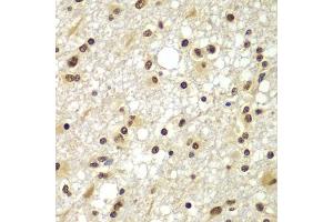 Immunohistochemistry of paraffin-embedded human brain cancer using ZNF20 antibody (ABIN5975115) at dilution of 1/100 (40x lens). (ZNF20 抗体)
