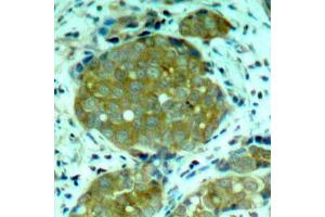 Immunohistochemistry of paraffin-embedded human breast carcinoma using Phospho-NFKB1-S932 antibody (ABIN2988211). (NFKB1 抗体  (pSer932))