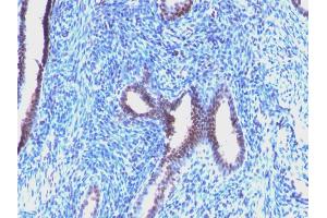 Formalin-fixed, paraffin-embedded human Endometrial Carcinoma stained with Cyclin B1 Mouse Monoclonal Antibody (CCNB1/1098). (Cyclin B1 抗体)