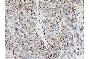 Immunohistochemical staining of paraffin-embedded Adenocarcinoma of Human breast tissue using anti-ANAPC2 mouse monoclonal antibody. (ANAPC2 抗体)