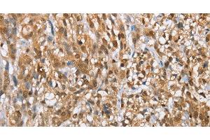 Immunohistochemistry of paraffin-embedded Human esophagus cancer tissue using MMP12 Polyclonal Antibody at dilution of 1:60 (MMP12 抗体)