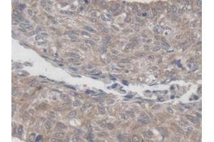 DAB staining on IHC-P; Samples: Human Lung cancer Tissue (MRPL1 抗体  (AA 147-285))