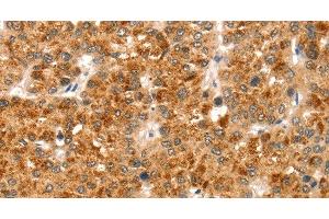 Immunohistochemistry of paraffin-embedded Human liver cancer using CCS Polyclonal Antibody at dilution of 1:35 (Superoxide dismutase copper chaperone 抗体)