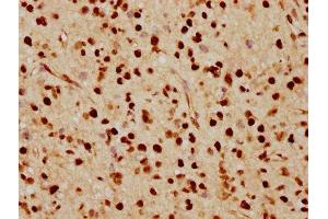 IHC image of ABIN7127502 diluted at 1:70 and staining in paraffin-embedded human glioma cancer performed on a Leica BondTM system. (Recombinant FTO 抗体)