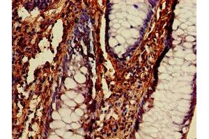 IHC image of ABIN7145343 diluted at 1:400 and staining in paraffin-embedded human colon cancer performed on a Leica BondTM system. (Beclin 1 抗体  (AA 1-100))