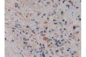 Detection of NGAL in Human Prostate cancer Tissue using Polyclonal Antibody to Neutrophil gelatinase-associated lipocalin (NGAL) (Lipocalin 2 抗体  (AA 21-198))