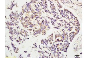 Formalin-fixed and paraffin embedded human rectal carcinoma labeled with Rabbit Anti CYP2E1 Polyclonal Antibody, Unconjugated (ABIN707141) at 1:200 followed by conjugation to the secondary antibody and DAB staining