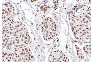 ABIN6268903 at 1/200 staining human Breast cancer tissue sections by IHC-P. (P18 INK 抗体)