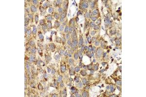 Immunohistochemistry of paraffin-embedded human lung cancer using SHMT2 Antibody.