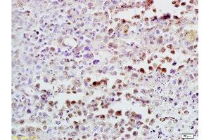 Formalin-fixed and paraffin embedded mouse lymphoma tissue labeled with Anti-CDK4 Polyclonal Antibody , Unconjugated at 1:300, followed by conjugation to the secondary antibody and DAB staining (CDK4 抗体  (AA 241-303))