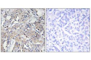 Immunohistochemistry analysis of paraffin-embedded human breast carcinoma tissue using COL6A3 antibody. (COL6a3 抗体  (Internal Region))
