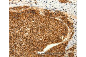 Immunohistochemistry of Human lung cancer using TRPC6 Polyclonal Antibody at dilution of 1:50 (TRPC6 抗体)