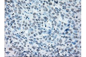 Immunohistochemical staining of paraffin-embedded Adenocarcinoma of colon tissue using anti-IRF3mouse monoclonal antibody. (IRF3 抗体)