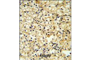 TRAP Antibody IHC analysis in formalin fixed and paraffin embedded kidney carcinoma followed by peroxidase conjugation of the secondary antibody and DAB staining. (CD40 Ligand 抗体  (C-Term))