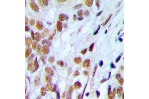 Immunohistochemical analysis of Lupus La (pS366) staining in human prostate cancer formalin fixed paraffin embedded tissue section. (Lupus La (C-Term), (pSer366) 抗体)