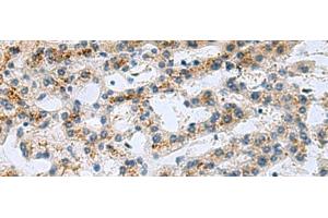 Immunohistochemistry of paraffin-embedded Human liver cancer tissue using GHRHR Polyclonal Antibody at dilution of 1:40(x200) (GHRHR 抗体)