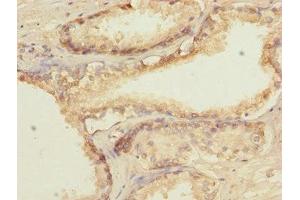 Immunohistochemistry of paraffin-embedded human prostate cancer using ABIN7172660 at dilution of 1:100 (GTF2A2 抗体  (AA 1-109))