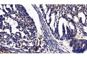 Detection of ITGaV in Human Ovarian cancer Tissue using Polyclonal Antibody to Integrin Alpha V (ITGaV)