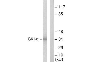 Immunohistochemistry analysis of paraffin-embedded human lung carcinoma tissue using CKI-α antibody. (CSNK1A1 抗体)