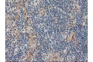 Immunohistochemical staining of paraffin-embedded Human lymphoma tissue using anti-CXorf26 mouse monoclonal antibody. (CXorf26 抗体)