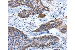 Immunohistochemistry of Human esophagus cancer using AQP8 Polyclonal Antibody at dilution of 1:75 (Aquaporin 8 抗体)