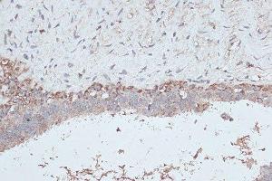 Immunohistochemistry of paraffin-embedded human breast cancer using MAP1LC3B antibody. (LC3B 抗体)