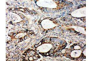 Anti-Integrin alpha 3 antibody,  IHC(P) IHC(P): Human Intestinal Cancer Tissue (ITGA3 抗体  (N-Term))