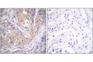 Immunohistochemistry analysis of paraffin-embedded human breast carcinoma, using Lck (Phospho-Tyr505) Antibody.