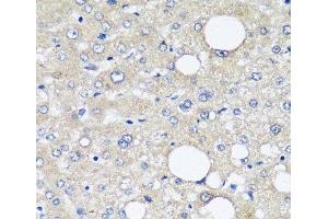 Immunohistochemistry of paraffin-embedded Human liver cancer using AFP Monoclonal Antibody at dilution of 1:12. (alpha Fetoprotein 抗体)