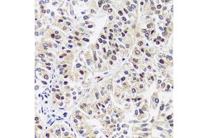 Immunohistochemistry of paraffin-embedded human uterine cancer using C antibody (ABIN7266546) at dilution of 1:100 (40x lens). (CAND1 抗体  (AA 750-980))