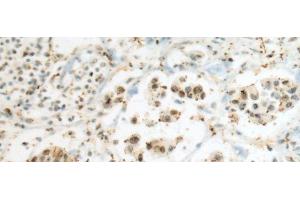 Immunohistochemistry of paraffin-embedded Human breast cancer tissue using SEPHS1 Polyclonal Antibody at dilution of 1:80(x200) (SEPHS1 抗体)