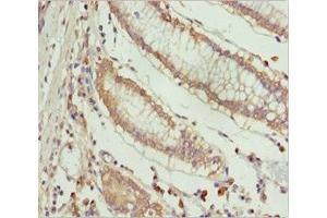 Immunohistochemistry of paraffin-embedded human colon cancer using ABIN7151996 at dilution of 1:100 (ERLIN2 抗体  (AA 212-339))