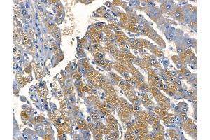 ABIN6259817 and ABIN6268680 at 1/100 staining Human liver cancer by IHC-P. (alpha Fetoprotein 抗体  (C-Term))