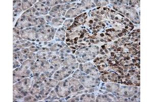 Immunohistochemical staining of paraffin-embedded Adenocarcinoma of colon tissue using anti-RC203219 mouse monoclonal antibody. (ACSBG1 抗体)