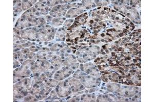 Immunohistochemical staining of paraffin-embedded Adenocarcinoma of colon tissue using anti-RC203219 mouse monoclonal antibody. (ACSBG1 抗体)