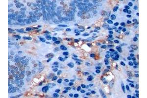 Detection of Ki-67 in Human Colorectal cancer Tissue using Polyclonal Antibody to Ki-67 Protein (Ki-67) (Ki-67 抗体  (AA 3088-3235))