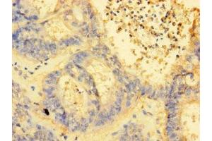 Immunohistochemistry of paraffin-embedded human endometrial cancer using ABIN7142407 at dilution of 1:100 (MRPL38 抗体  (AA 35-380))