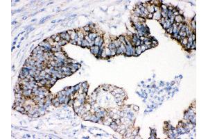 Anti- AIF Picoband antibody, IHC(P) IHC(P): Human Intestinal Cancer Tissue (AIF 抗体  (C-Term))