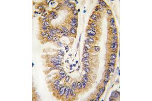 Formalin-fixed and paraffin-embedded human lung carcinoma tissue reacted with PTEN antibody (N-term) (ABIN6242545 and ABIN6579042) , which was peroxidase-conjugated to the secondary antibody, followed by DAB staining. (PTEN 抗体  (N-Term))