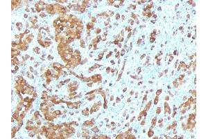 Formalin-fixed, paraffin-embedded human Melanoma stained with Melan-A / MART-1 Mouse Monoclonal Antibody (MLANA/788). (MLANA 抗体)