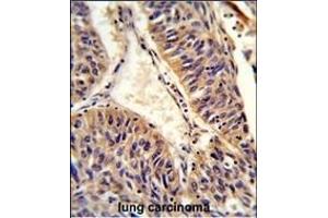 Formalin-fixed and paraffin-embedded human lung carcinoma reacted with ALG14 Antibody (Center), which was peroxidase-conjugated to the secondary antibody, followed by DAB staining. (ALG14 抗体  (AA 67-93))