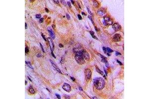 Immunohistochemical analysis of CEP78 staining in human lung cancer formalin fixed paraffin embedded tissue section. (CEP78 抗体)